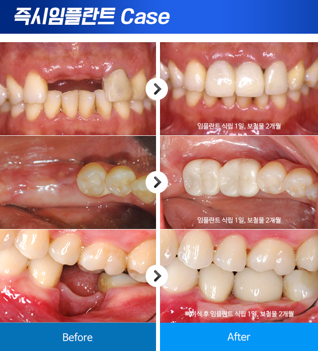 즉시임플란트 전후사진