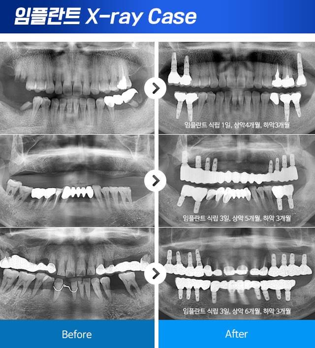 X-ray 임플란트 전후사진